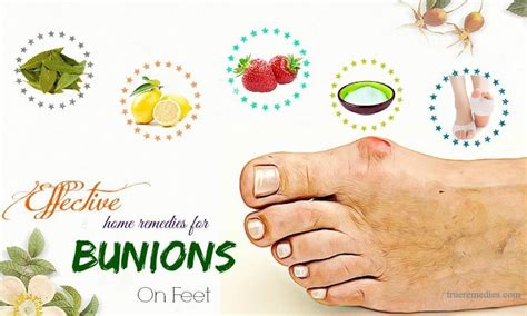 17 Effective Home Remedies For Bunions On Feet