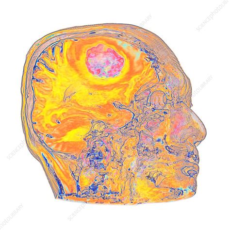 Metastatic Brain Cancer Mri Scan Stock Image C0374650 Science