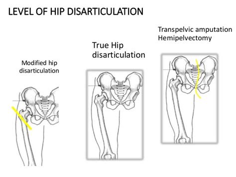 Hip Disarticulation Amputation