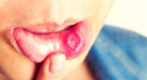 Kenapa bisa lidah buaya ampuh menghilangkan keloid ??? Petua Cara Merawat Ulser Mulut Yang Berkesan