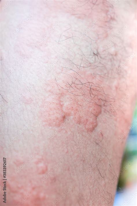 Urticaria On Skin Rashes Of Which Urticaria And Toxic Erythema Are
