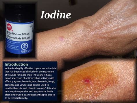 Iodine Helps Heal Wounds Sores Blisters Boils Fast