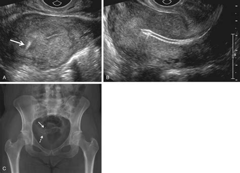 Ultrasound Evaluation Of The Fallopian Tube Radiology Key