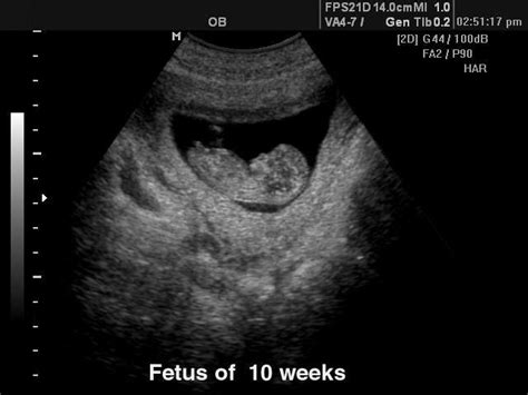 Ultrasound Images Fetus 10 Weeks B Mode Echogramm №118
