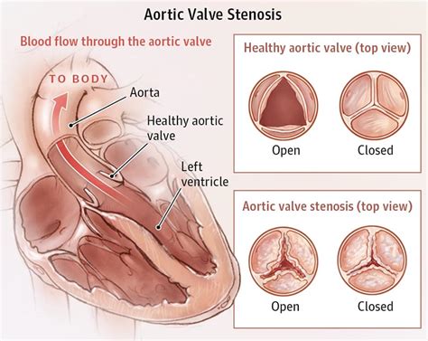 What Is Aortic Stenosis The Heart And Vascular Centre
