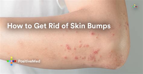 How To Get Rid Of Skin Bumps Positivemed