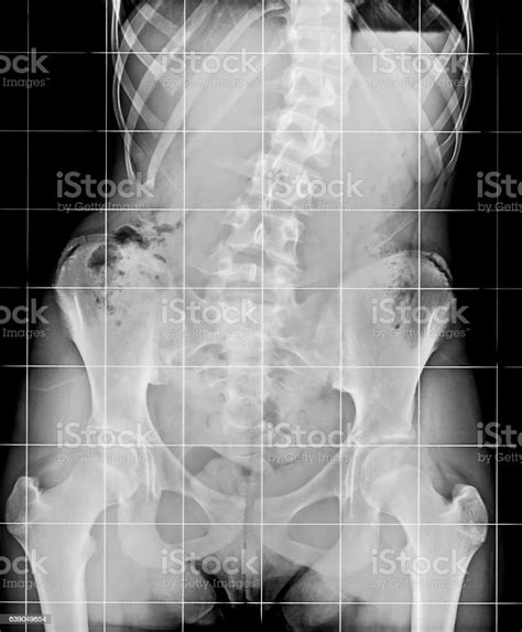 Xray Of The Spinal Column And Pelvis Stock Photo Download Image Now
