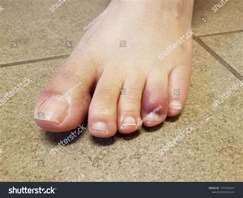 Womans Red Purple Bruised Toe On Stock Photo 1437020651 Shutterstock