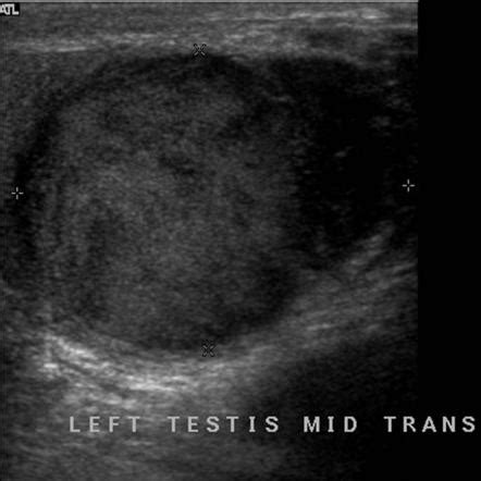 Testicular Abscess Radiology Reference Article Radiopaedia Org