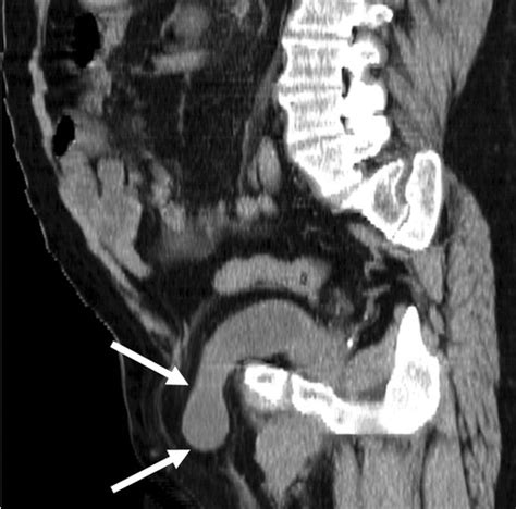 Abdominal Wall Hernias Imaging Features Complications And Diagnostic