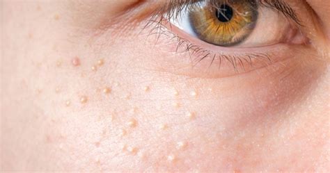 Small White Spots On Skin Wholesale Website Save 58 Jlcatj Gob Mx