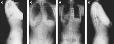 Adolescent Idiopathic Scoliosis The Lancet