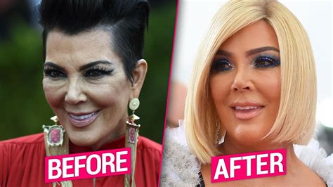 Kris Jenners Plastic Surgery Makeover Exposed By Top Docs