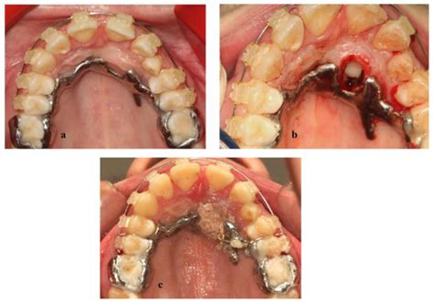 Dentistry Journal Free Full Text Orthodontic Treatment Of Palatally