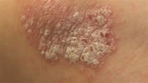 Collection Of Dark Scaly Spots On Skin 15 Signs That Reveal Serious