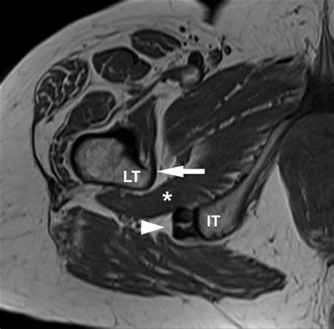 Axial T1 Weighted Mri Sequence Showing The Anatomy Of The Ifs In