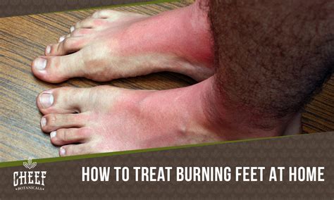Home Remedies For Burning Feet 12 Easy Remidies