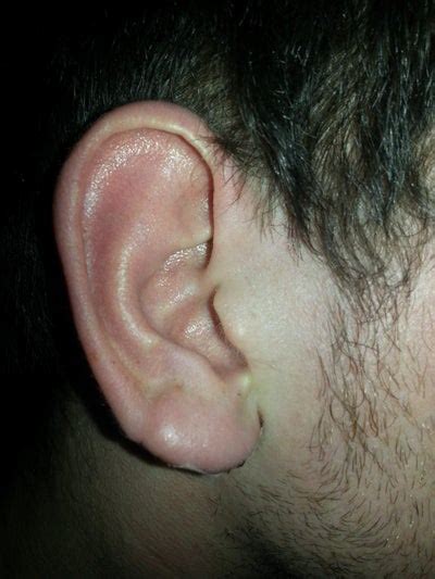 Is This Normal Bruisingswelling After An Earlobe Reduction How Long