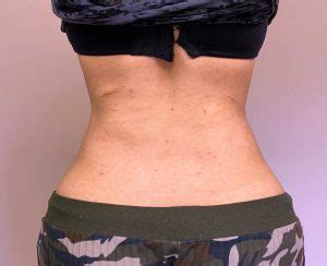 Waist Narrowing Rib Removal Plastic Surgeon Dr Barry L Eppley MD