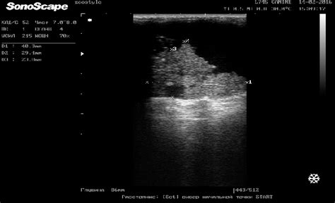 Ultrasound Image Of Adenocarcinoma Of The Mammary Gland Burdened With