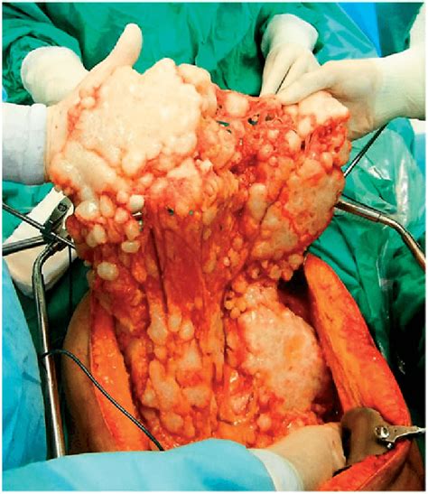 Peritoneal mesothelioma is a cancer found in a thin membrane surrounding the abdomen known as the peritoneum. Malignant peritoneal mesothelioma in the form of 'omental ...