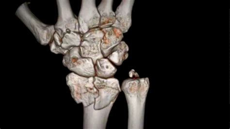 Ulnar Styloid Fracture Causes Diagnosis Treatment Rxharun
