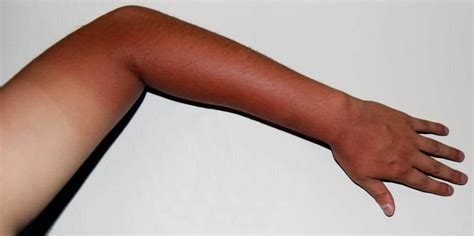 Dark Skin Turns UV Rays To Heat Rendering Them Harmless ScienceBlog Com