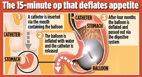 Elipse Gastric Balloons Latest Diet Plan Is To Swallow Device Filled