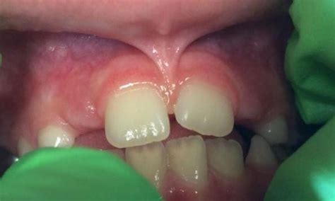 Upper Lip Frenectomy With Erupting Adult Dentition Before And After Photos Austin Tx