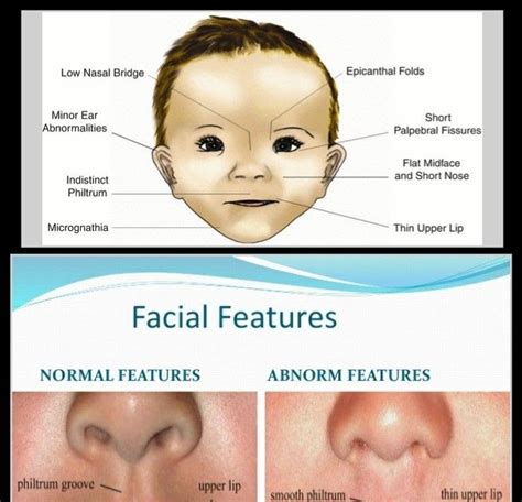 Flat Nasal Bridge And Epicanthal Folds Meaning Of Epicanthal Folds