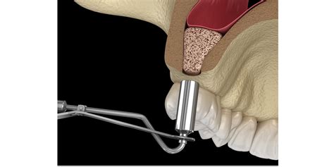 What Is Sinus Lift Vivid Dental Surgeons