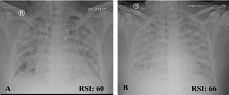 The Chest X Ray Radiologic Severity Index As A Determinant Of The