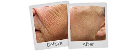 Ipl Skin Treatments Newcastle Laser Clinic