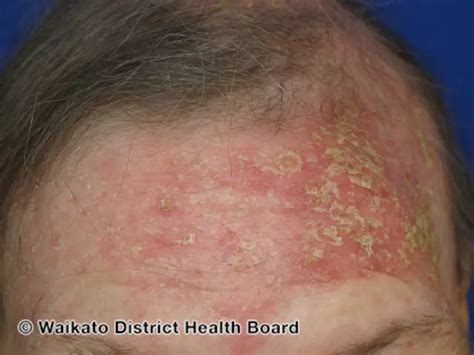 What Is Sebopsoriasis How Its Diagnosed And Treated Mypsoriasisteam