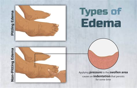 What Is Edema 6 Types Symptoms And Causes 2022
