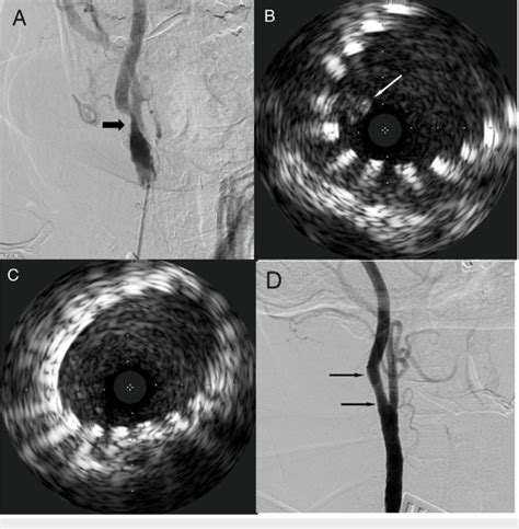 Digital Subtraction Carotid Angiogram And Intravascular Ultrasound