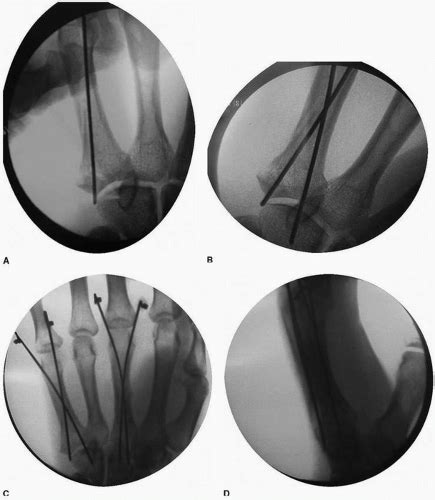 Operative Treatment Of Metacarpal Fractures Musculoskeletal Key