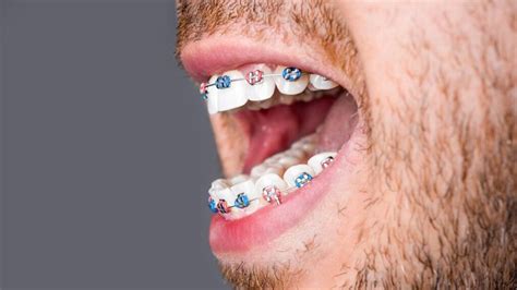 Adult Ceramic Braces Vs Invisalign Which Is Better