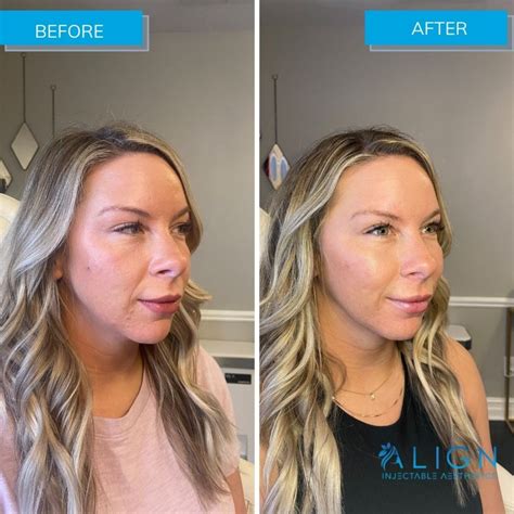 Cheekmidface Filler Archives Align Injectable Aesthetics