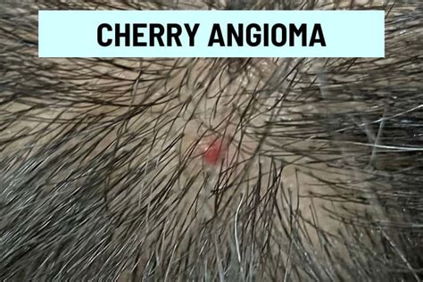 Red Spots On Scalp 11 Causes Pictures And Treatment