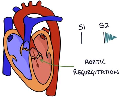 Murmurs Zero To Finals Aortic Stenosis Mitral Valve Heart Sounds