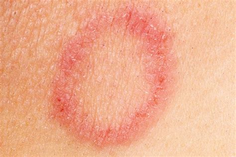 Ringworm Rash Causes