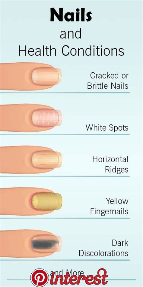 This Is What Your Nails Try To Tell About Your Health This Is What Your
