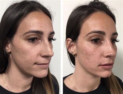 What Type Of Filler Is Best For Your Cheeks Cheek Fillers Cheek