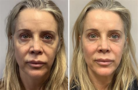 Dark Circles Under Eye Issues Forever Young Laser And Skin Center