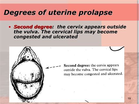 [40 ] Photographs Uterine Prolapse Stages