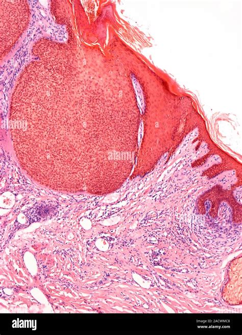 Skin Cancer Light Micrograph Of A Section Through A Basal Cell