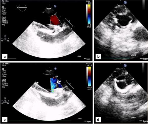 A Durable Porcine Pericardial Surgical Bioprosthetic Heart Valve A