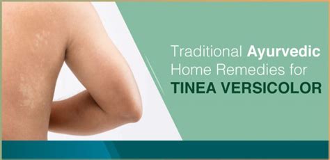 Traditional Ayurvedic Home Remedies For Tinea Versicolor