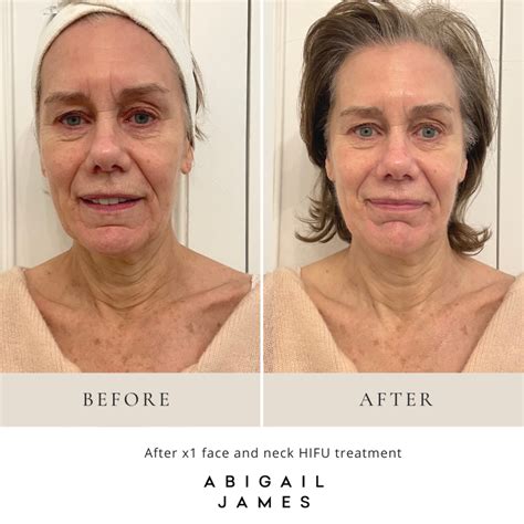 Judy Murrays Facial Treatments Abigail James